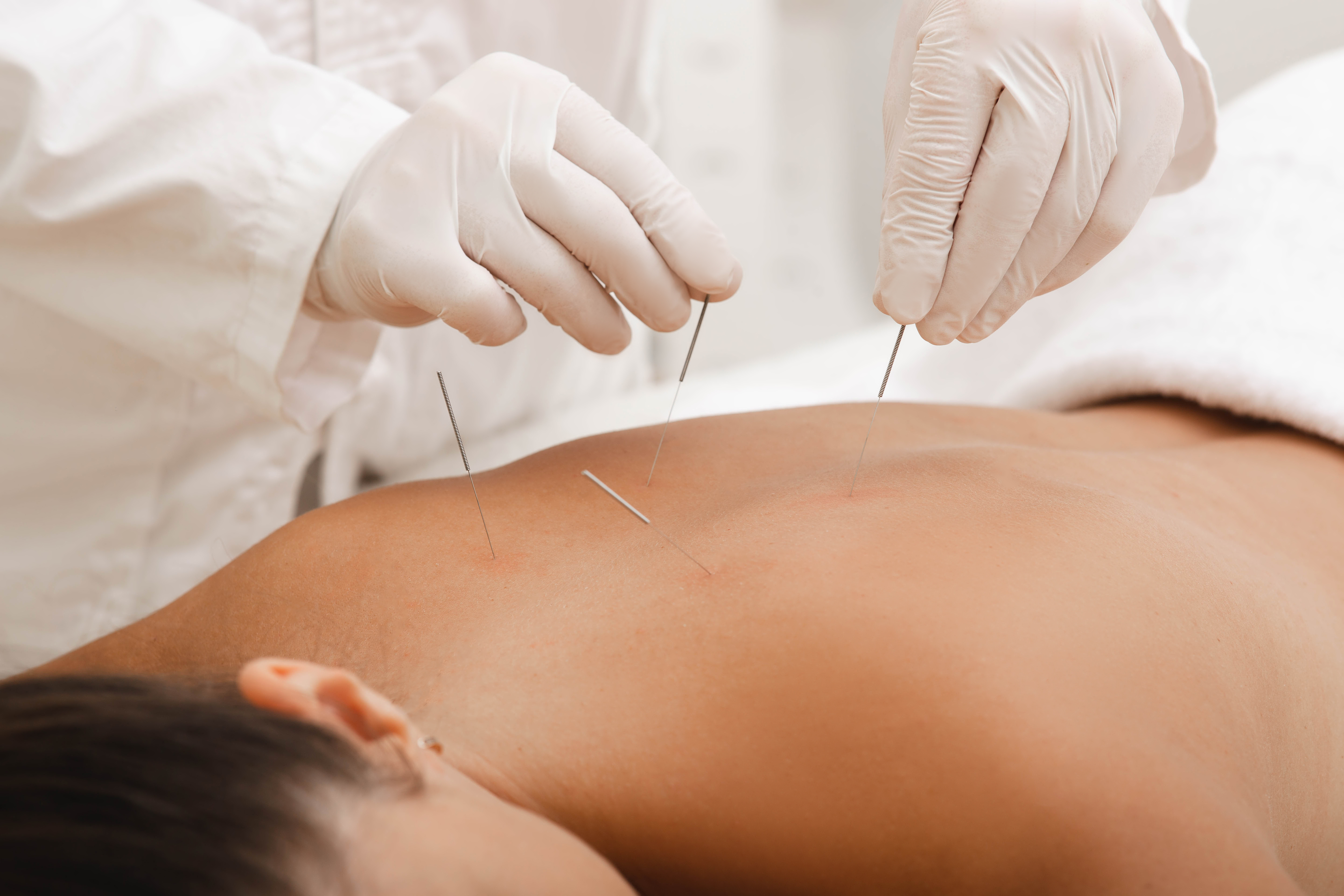 Acupuncture, Cupping & Moxibustion